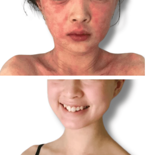 Eczema treatment on face before and after 'The Chronic Solution'  