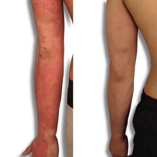 Eczema treatment on arm before and after 'The Chronic Solution'  