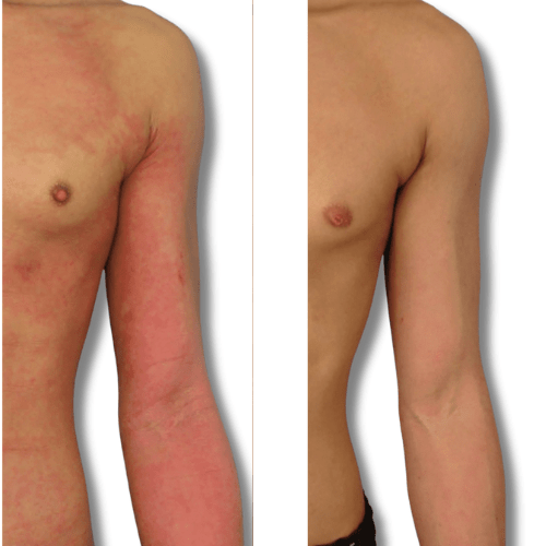 Eczema treatment upper body before and after 'The Chronic Solution'  