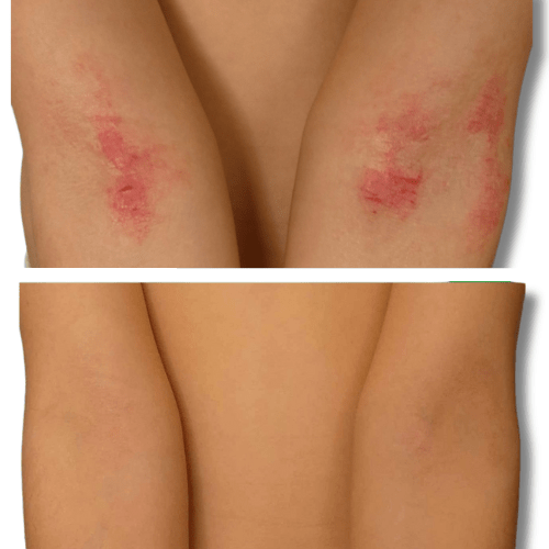 Eczema treatment on elbows before and after 'The Chronic Solution'  