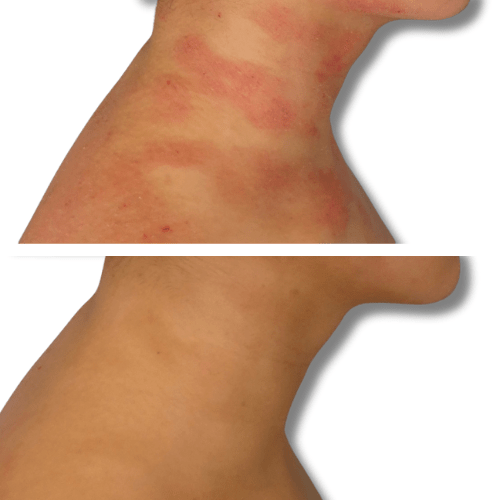 Eczema treatment on neck before and after 'The Chronic Solution'  