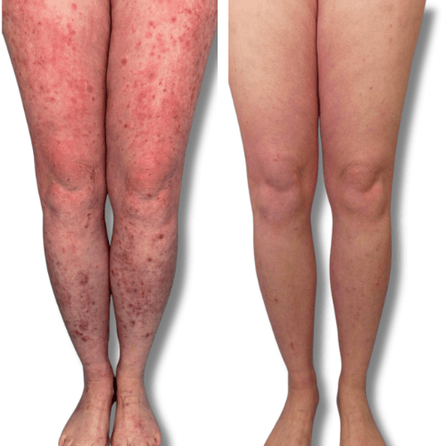 Eczema treatment on legs before & after 'The Chronic Solution'