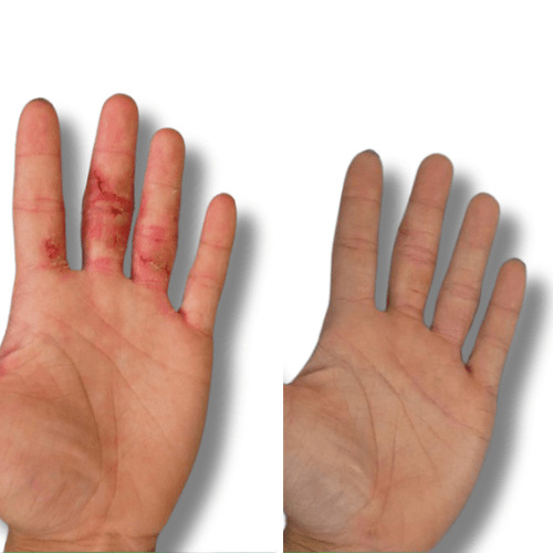 Eczema treatment on hands before and after 'The Chronic Solution'  