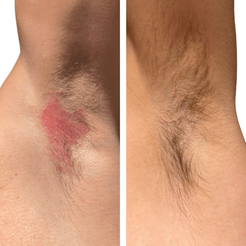 Eczema treatment on armpit before and after 'The Chronic Solution'  