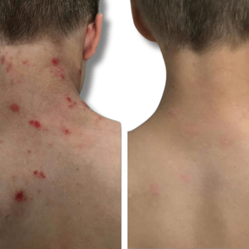 Eczema treatment on back before and after 'The Chronic Solution'  